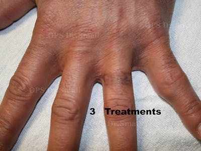 Tattoo Removal Before & After Gallery - Patient 377894 - Image 2