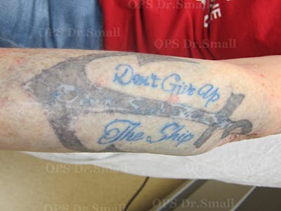 Tattoo Removal Before & After Gallery - Patient 310060 - Image 1