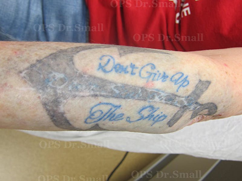Tattoo Removal Before & After Gallery - Patient 310060 - Image 1