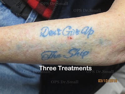 Tattoo Removal Before & After Gallery - Patient 310060 - Image 2
