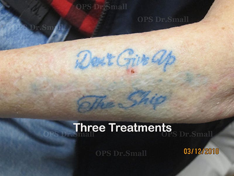 Tattoo Removal Before & After Gallery - Patient 310060 - Image 2