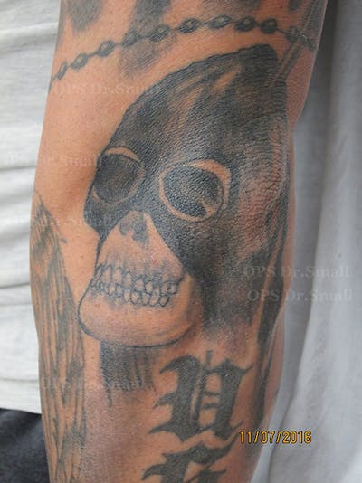 Tattoo Removal Before & After Gallery - Patient 199323 - Image 1