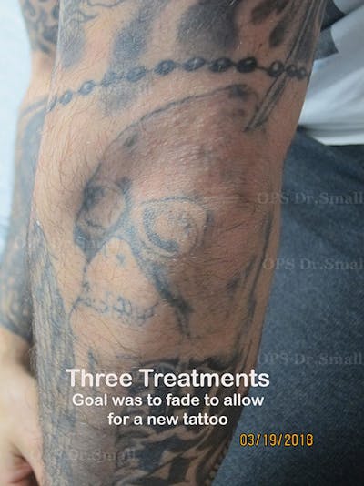 Tattoo Removal Before & After Gallery - Patient 199323 - Image 2