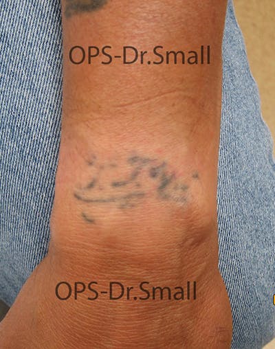Tattoo Removal Before & After Gallery - Patient 221073 - Image 1