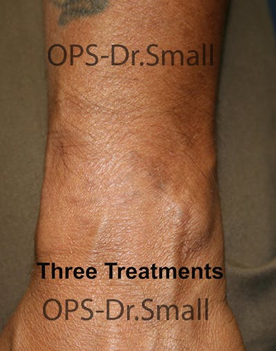 Tattoo Removal Before & After Gallery - Patient 221073 - Image 2