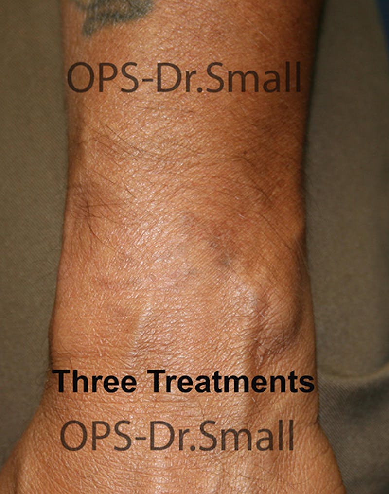 Tattoo Removal Before & After Gallery - Patient 221073 - Image 2