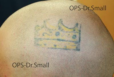 Tattoo Removal Before & After Gallery - Patient 508407 - Image 1