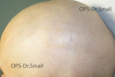 Tattoo Removal Before & After Gallery - Patient 508407 - Image 2