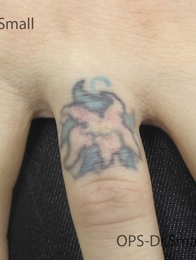 Tattoo Removal Before & After Gallery - Patient 722453 - Image 1