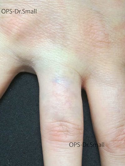 Tattoo Removal Before & After Gallery - Patient 722453 - Image 2