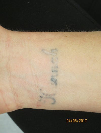 Tattoo Removal Before & After Gallery - Patient 100900 - Image 1