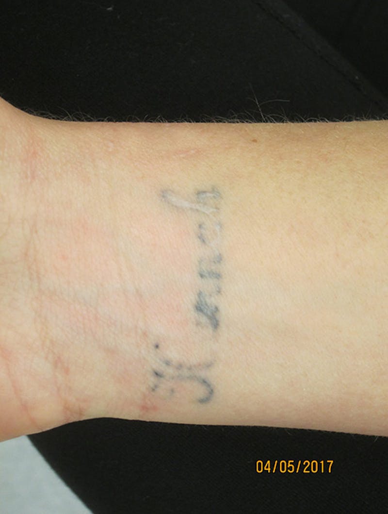 Tattoo Removal Before & After Gallery - Patient 100900 - Image 1