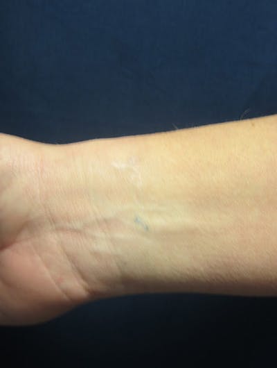 Tattoo Removal Before & After Gallery - Patient 100900 - Image 2