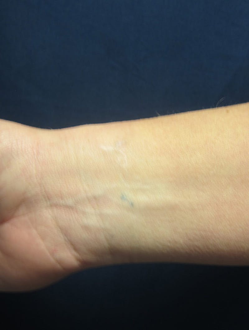 Tattoo Removal Before & After Gallery - Patient 100900 - Image 2