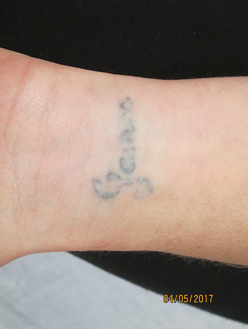 Tattoo Removal Before & After Gallery - Patient 168981 - Image 1