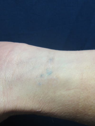 Tattoo Removal Before & After Gallery - Patient 168981 - Image 2