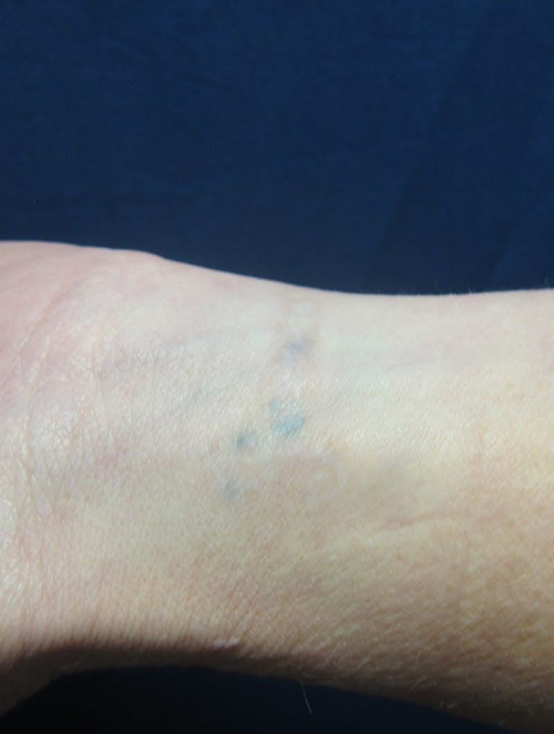 Tattoo Removal Before & After Gallery - Patient 168981 - Image 2