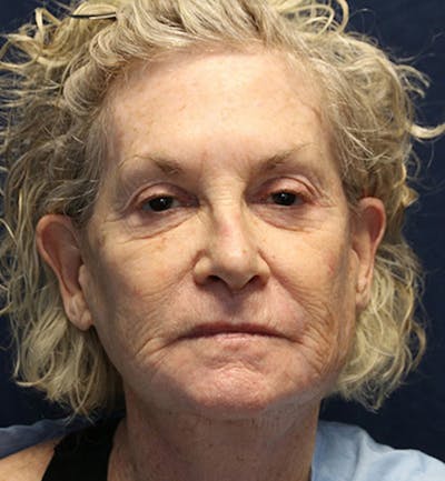 Skin Rejuvenation Before & After Gallery - Patient 271206 - Image 1
