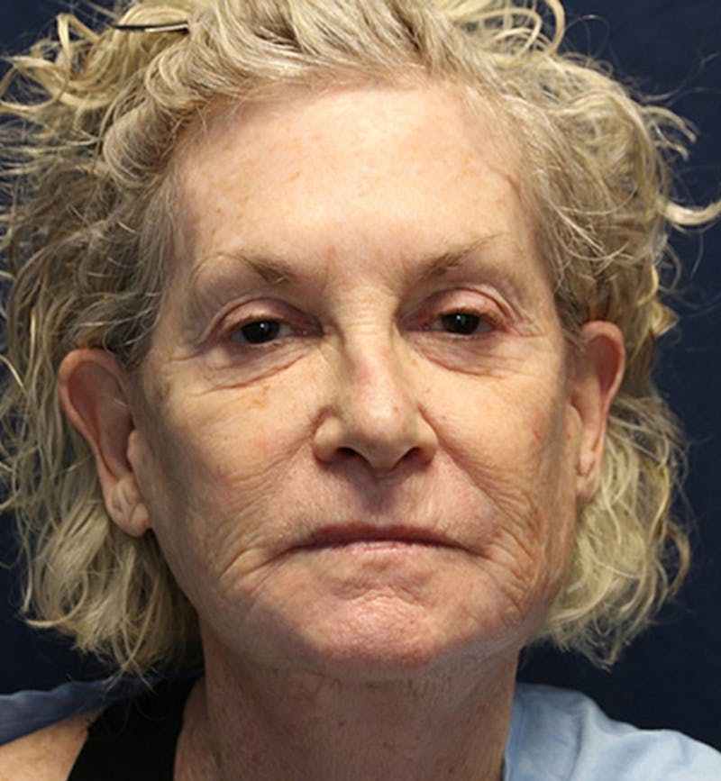 Skin Rejuvenation Before & After Gallery - Patient 271206 - Image 1