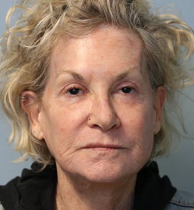 Skin Rejuvenation Before & After Gallery - Patient 271206 - Image 2