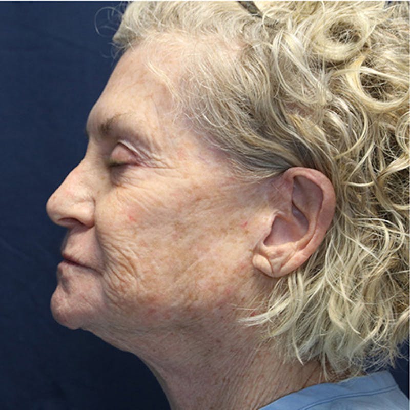 Skin Rejuvenation Before & After Gallery - Patient 271206 - Image 3