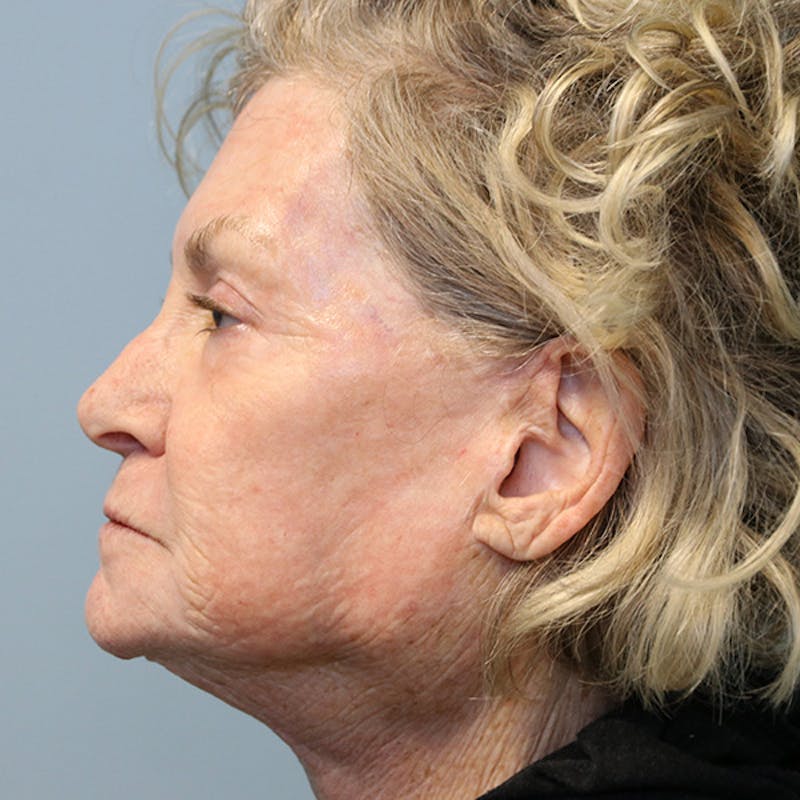 Skin Rejuvenation Before & After Gallery - Patient 271206 - Image 4