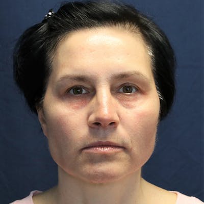 Skin Rejuvenation Before & After Gallery - Patient 425532 - Image 1