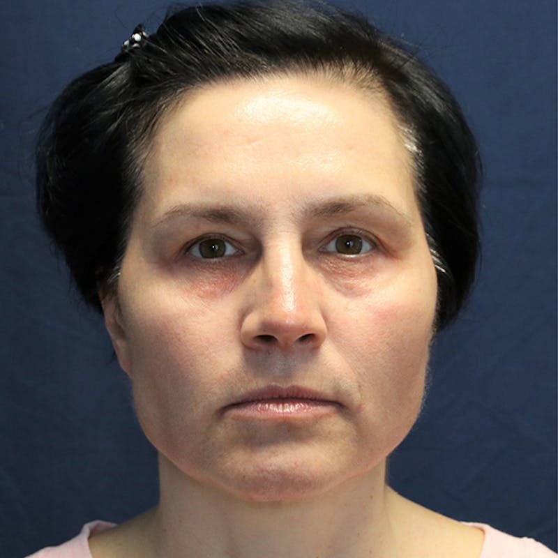 Skin Rejuvenation Before & After Gallery - Patient 425532 - Image 1