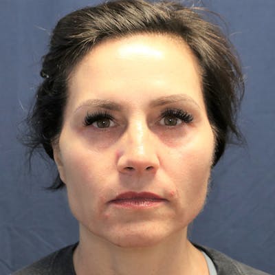 Skin Rejuvenation Before & After Gallery - Patient 425532 - Image 2