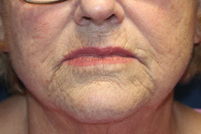 Skin Rejuvenation Before & After Gallery - Patient 300610 - Image 1