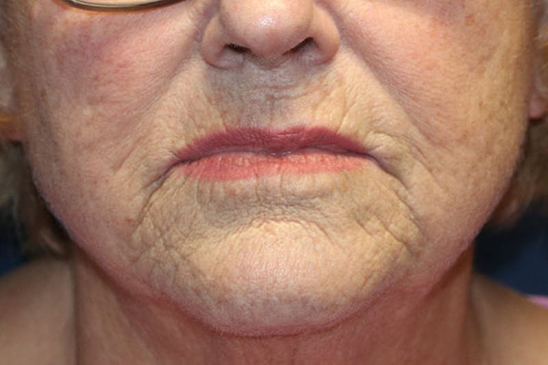 Skin Rejuvenation Before & After Gallery - Patient 300610 - Image 1