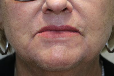 Skin Rejuvenation Before & After Gallery - Patient 300610 - Image 2