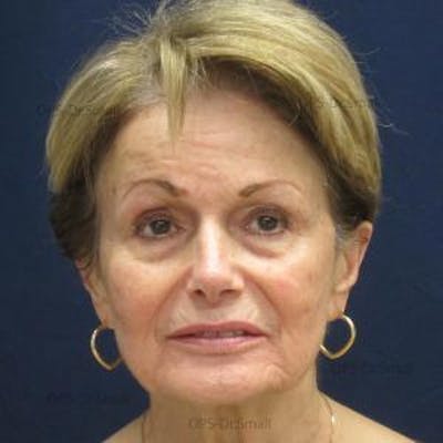 Skin Rejuvenation Before & After Gallery - Patient 374107 - Image 1