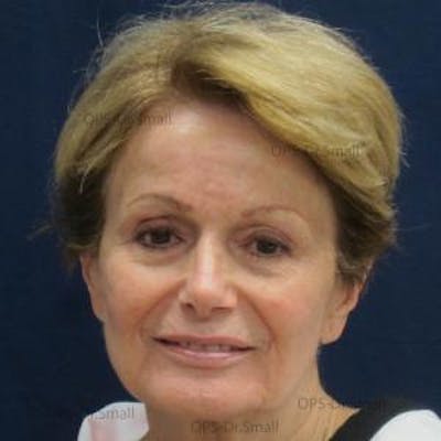 Skin Rejuvenation Before & After Gallery - Patient 374107 - Image 2