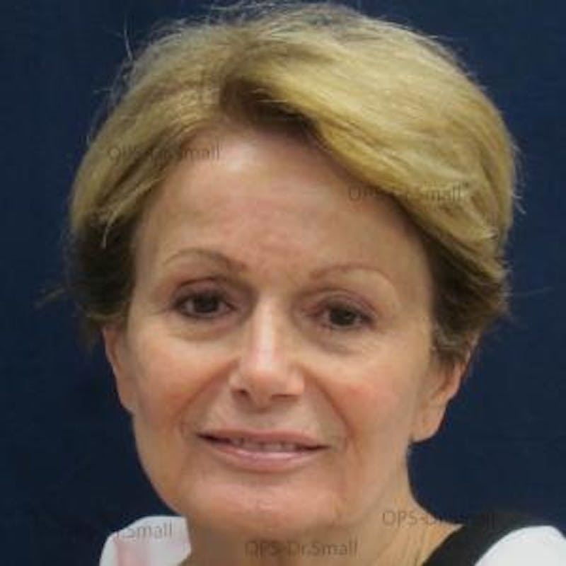 Skin Rejuvenation Before & After Gallery - Patient 374107 - Image 2