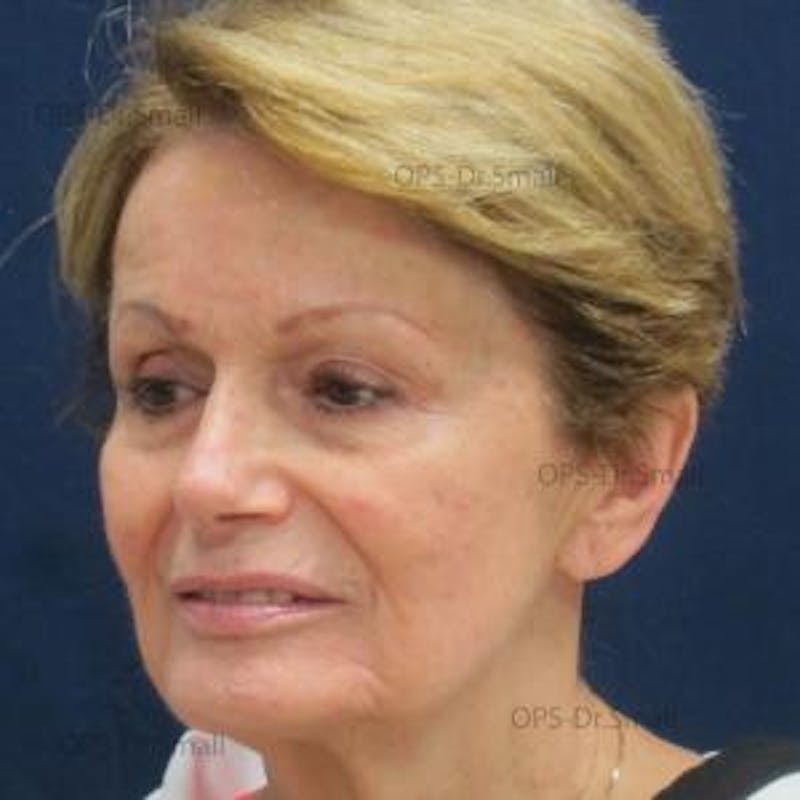 Skin Rejuvenation Before & After Gallery - Patient 374107 - Image 4