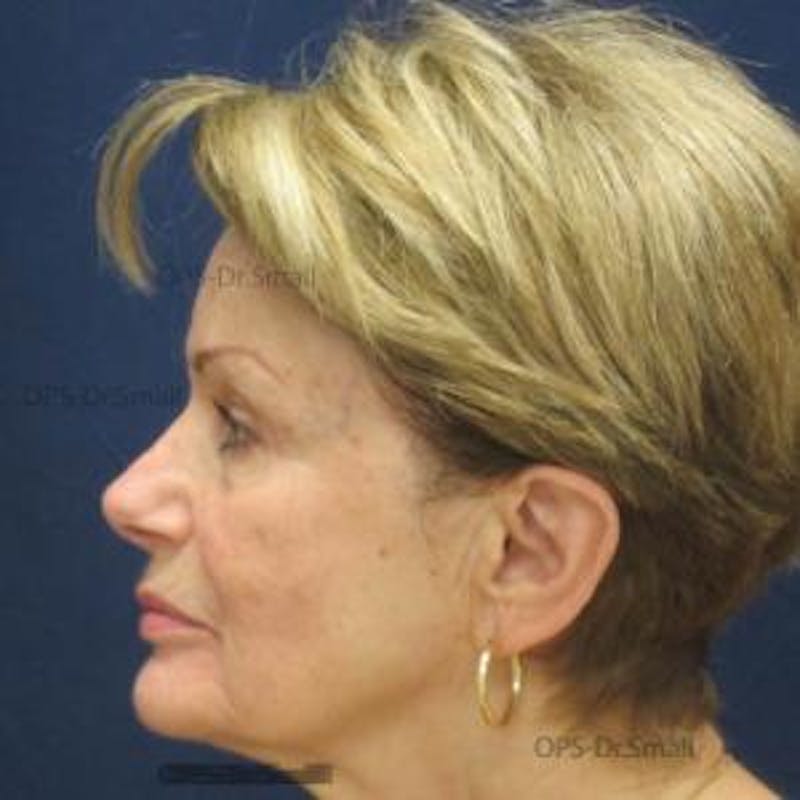 Skin Rejuvenation Before & After Gallery - Patient 374107 - Image 5