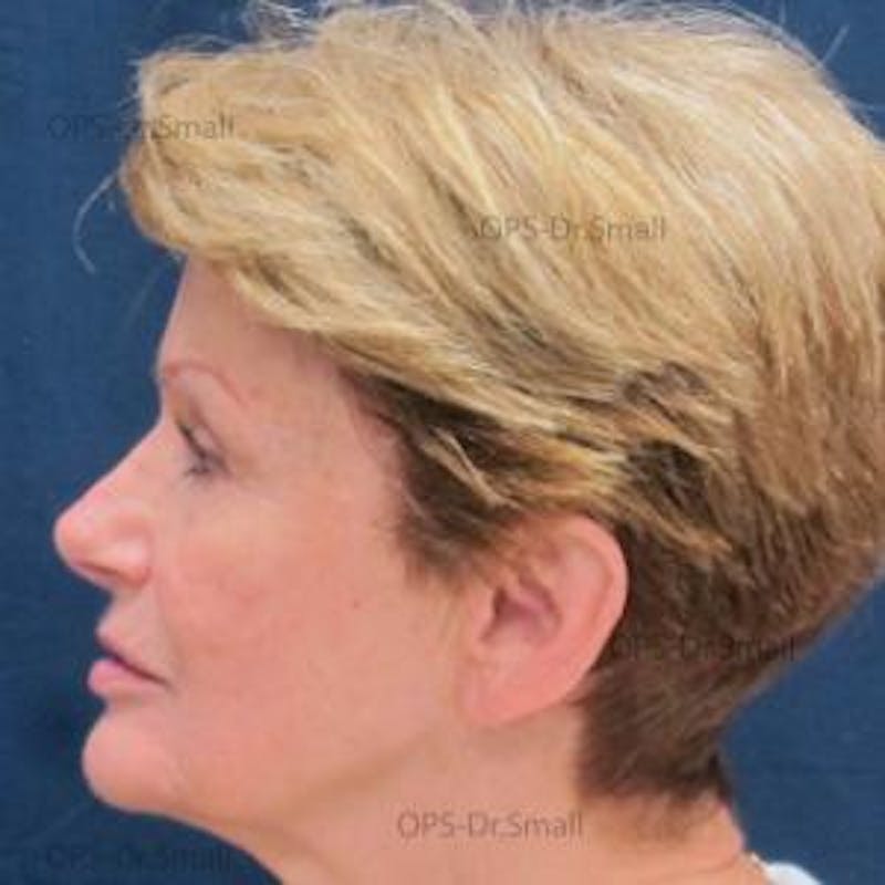 Skin Rejuvenation Before & After Gallery - Patient 374107 - Image 6