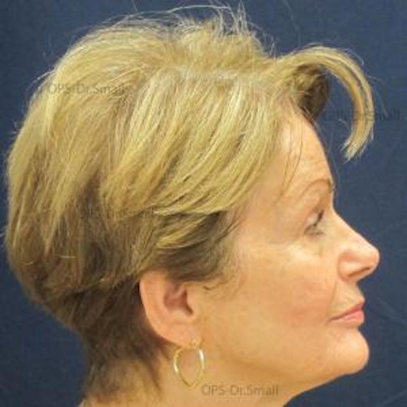Skin Rejuvenation Before & After Gallery - Patient 374107 - Image 7