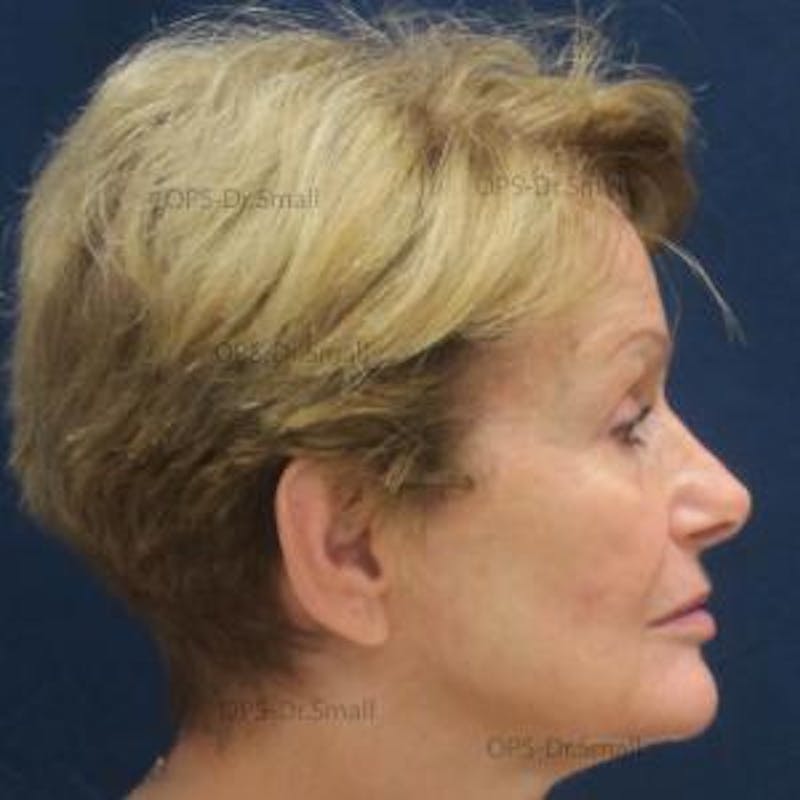 Skin Rejuvenation Before & After Gallery - Patient 374107 - Image 8