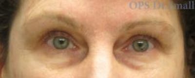 Blepharoplasty (Eyelids) Before & After Gallery - Patient 422882 - Image 1