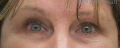 Blepharoplasty (Eyelids) Before & After Gallery - Patient 422882 - Image 2