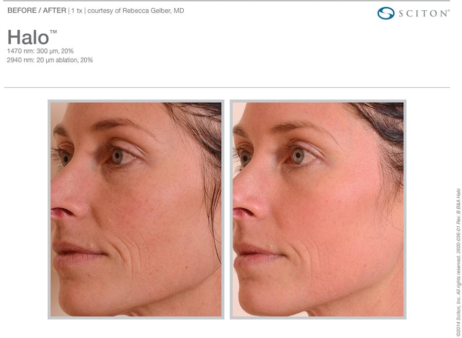 halo before and after