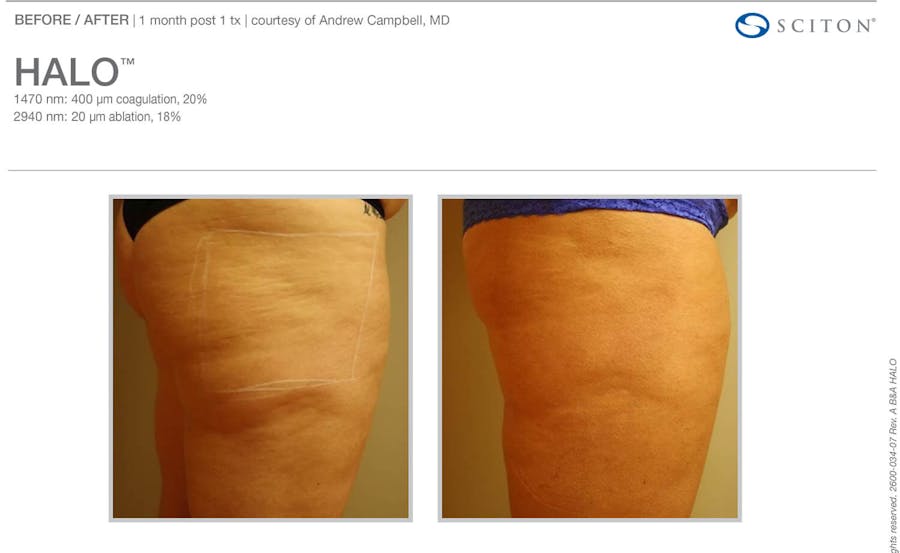 halo before and after