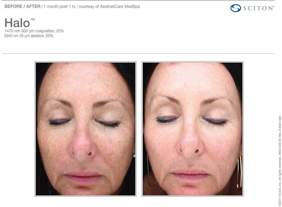 halo before and after