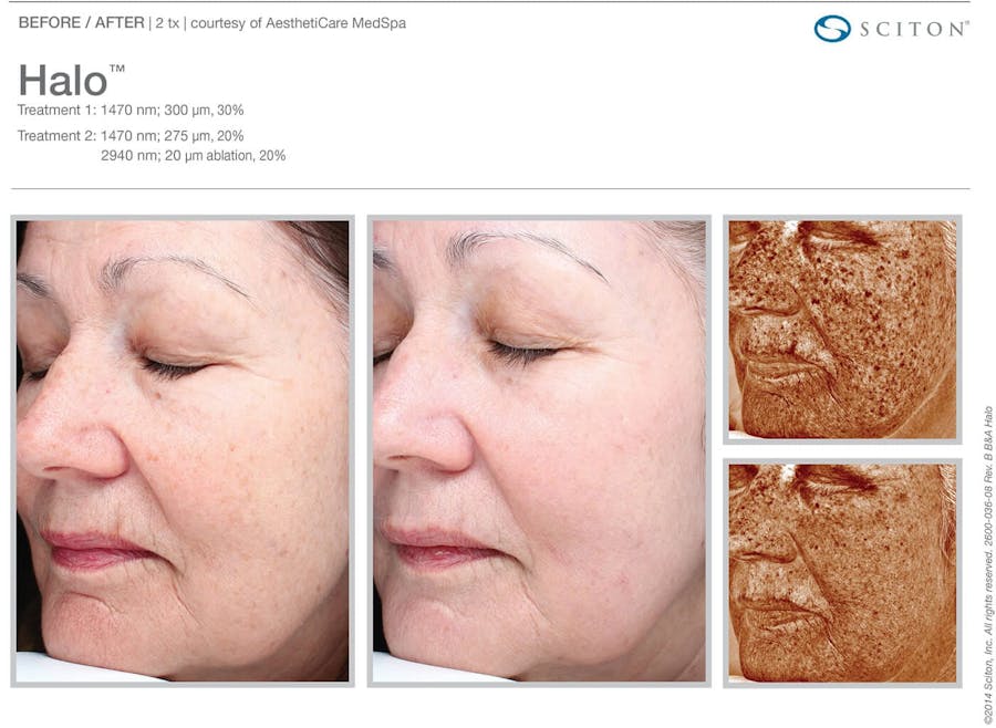 halo before and after