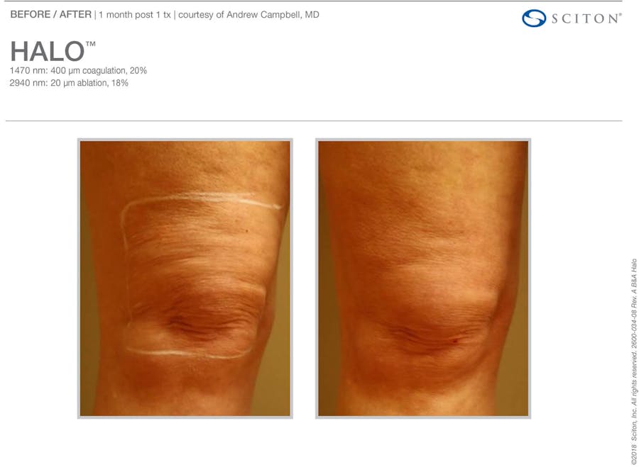 halo before and after