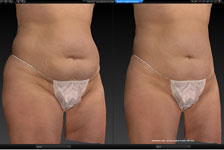 vectra xt imaging