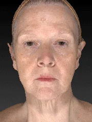 vectra xt imaging