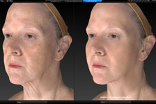 vectra xt imaging
